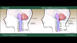 Chiari Malformation amp Syringomyelia [upl. by Pierro]