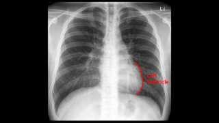 Chest xray interpretation [upl. by Havot]