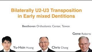 Bilaterally U2U3 Transposition in Early mixed Dentitons｜【Chris Chang Ortho】CC443 [upl. by Nosniv]