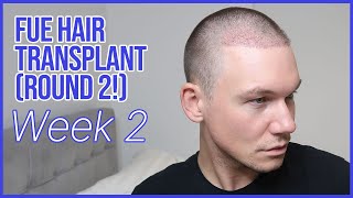 WEEK 2  FUE Hair Transplant Round 2  Removing Scabs and Losing Hair Shafts [upl. by Irtimd477]