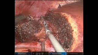 Simultaneous Robotic Right Colectomy with Intracorporeal Anastomosis and Partial Hepatectomy [upl. by Acnayb]