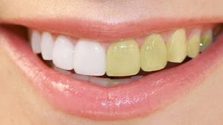 Photoshop Tutorial  How to Make Whitening Teeth [upl. by Yeliab]