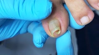 Removal of severely curved ingrown toenail  Satisfying video [upl. by Earle995]