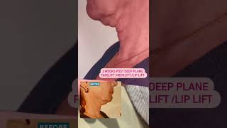 Dramatic Transformation 2 Weeks Post Deep Plane Face amp Neck lift [upl. by Swee176]