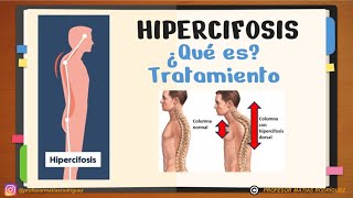 ✅ CIFOSIS e HIPERCIFOSIS dorsal explicación Ejercicios para corregir [upl. by Booth]