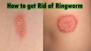 Ringworm Treatment At Home  7 Steps on How to Cure Ringworm Fast [upl. by Enilraep]