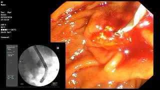 ERCP  Distal CBD stricture for FCSEMS [upl. by Oriole795]