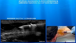 Ultrasound Guided Atypical Olecranon Bursitis Aspiration and Cortisone Injection by probeultrasound [upl. by Ecinaj992]