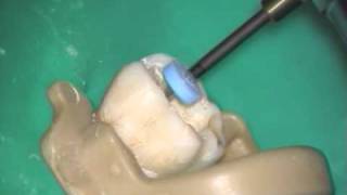 BioRaCe Retreatment  Molar [upl. by Storz]