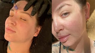 Nano Needling Facial with me 💉 VLOG  pedicure chemical peel dermaplane [upl. by Nabe]