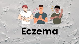 Eczema causes and treatment explained in Hindi [upl. by Ima222]