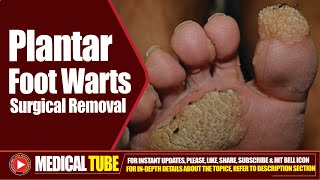 Foot Plantar Warts  Surgical Removal Treatment  How to Remove Plantar Warts ❌🦠 [upl. by Holzman]