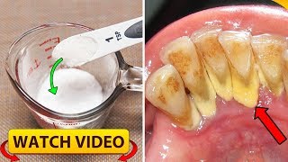 Mouthwash Removes Plaque From Teeth only In 2 Minutes [upl. by Giannini]