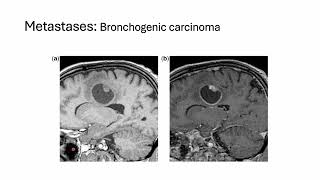 Diagnosing brain tumors can be a complex process [upl. by Mcgruter]