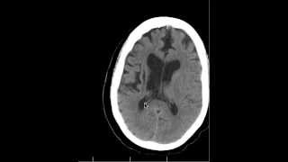 CT Chronic Basal Ganglia infarcts and Anatomy DISCUSSION by Radiologist [upl. by Anelrihs903]