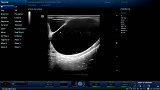 Multiple Epididymal cysts  Diagnostic ultrasound cases [upl. by Braasch]