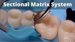 Class 2 restoration molar amp Premolar  Sectional Matrix Tips amp Tricks  Dentsply Palodent amp Bioclear [upl. by Savannah366]