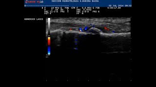 Ecografía fractura metatarsiano sin alteraciones en la radiografía [upl. by Thrift91]