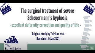 The surgical treatment of severe Scheuermann’s kyphosis [upl. by Henrieta]