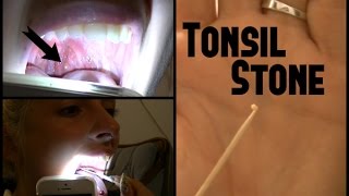 Tonsil Stone REMOVAL [upl. by Canfield]