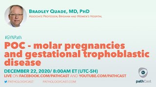 POC  molar pregnancies and gestational trophoblastic disease  Dr Quade BWH OBPATH [upl. by Eitsrik362]