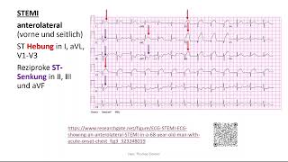 Herz 11 EKG 4  STEMI Perikarditis Extrasystole Kammerflimmern [upl. by Lleraj]