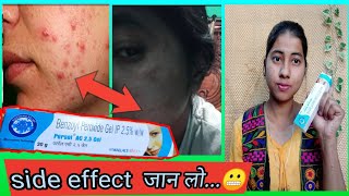 Benzoyl Peroxide Gel 25 Review In Hindi  Uses And Side Effect  miss glossy girl [upl. by Chiles286]