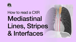 How to Read a Chest XRay Mediastinal Lines Stripes amp Interfaces [upl. by Gora]