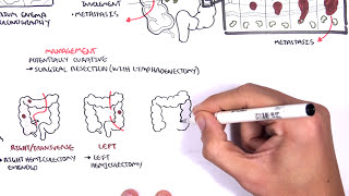 Colorectal Cancer  Overview [upl. by Dorkus305]