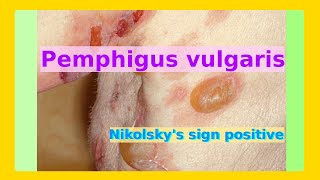 pemphigus vulgaris [upl. by Bergh468]