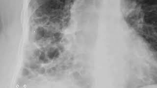 Chest Xray in Bronchiectasis Findings radiology cxr [upl. by Lakym]