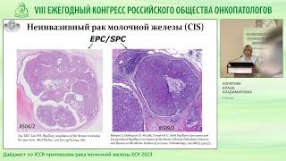 Дайджест по ICCR протоколам рака молочной железы ЕСР 2023 [upl. by Juanne]