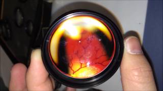 Trying handheld smartphone fundoscopy on practice eyes [upl. by Niwhsa]