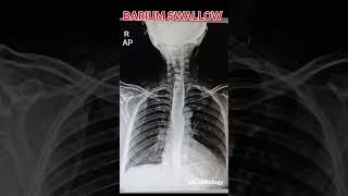 BARIUM SWALLOW X RAY RDIOLOGY [upl. by Malan]