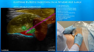 Ultrasound Guided Iliopsoas Bursts Injection by probeultrasound [upl. by Oirifrop585]