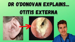 Explaining Otitis Externa  With Dr ODonovan [upl. by Nylimaj]