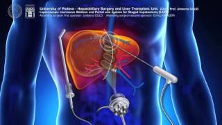 Modified ALPPS totally laparoscopic LAPS  ALPPS modificata LAPS totalmente laparoscopica [upl. by Akisej69]