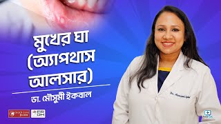 মুখের ঘা অ্যাপথাস আলসার Aphthous ulcer treatment bangla [upl. by Flannery]