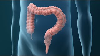 Treatments for Colorectal Cancer [upl. by Gagne908]