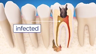 Root Canal Treatment Step by Step [upl. by Laird]