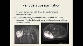 Les tumeurs osseuses malignes du Bassin [upl. by Bibi809]