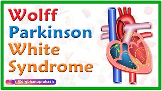 WolffParkinsonWhite Syndrome WPW  Causes Mechanism ECG Findings and diagnosis Treatment [upl. by Aohsoj]