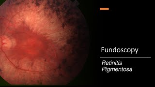 Retinitis Pigmentosa Fundoscopy [upl. by Hsekin]