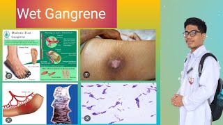 Wet Gangrene Pathology Why Moist Tissues Affected [upl. by Sitnalta219]