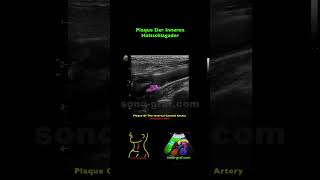 Duplexsonographie  Leichtgradige Stenose Der Arteria Carotis Interna [upl. by Britney]