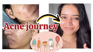 Severe ACNE cure journey in budget🥰❤️🤑 [upl. by Yendic389]