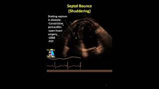 Septal Bounce shuddering constrictive pericarditis education [upl. by Assecnirp]