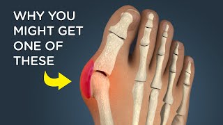 Bunions What Causes Them and How Theyre Removed [upl. by Dryfoos657]