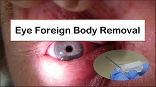 Eye Foreign Body Removal [upl. by Ruggiero101]