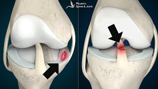 Is your knee pain coming from an ACL tear or Meniscus injury How to tell [upl. by Cuttler]